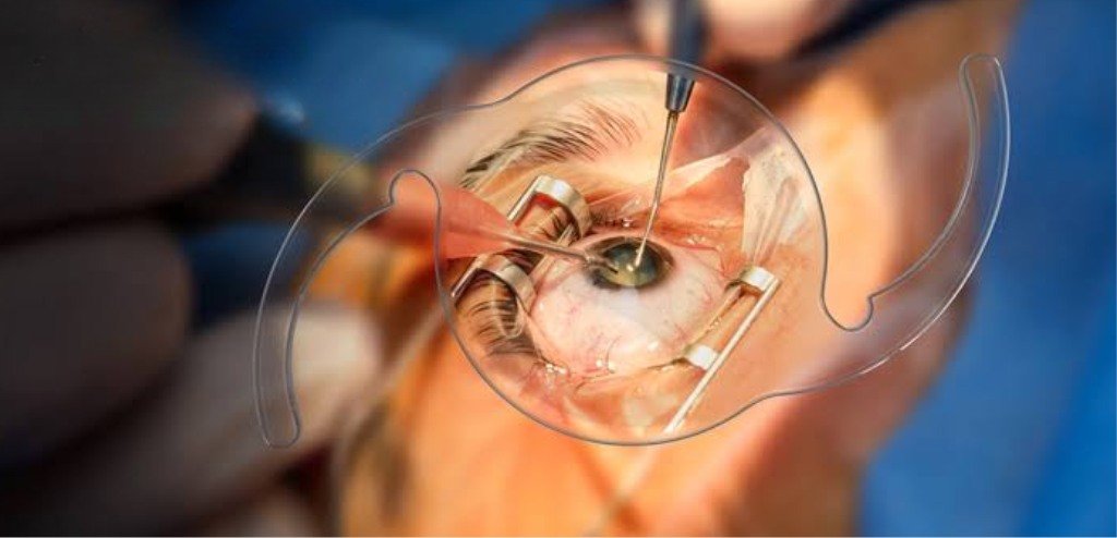cataract eye surgery